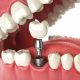 Implantes Dentales - Dental Alvarez