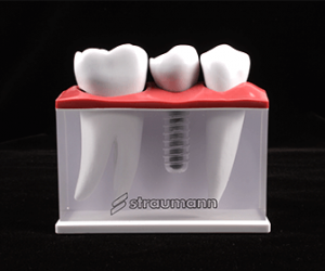 dental-alvarez-partes-de-un-implante-dental
