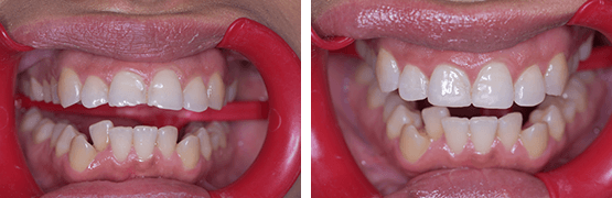 dental-procedure-before-and-after-tijuana