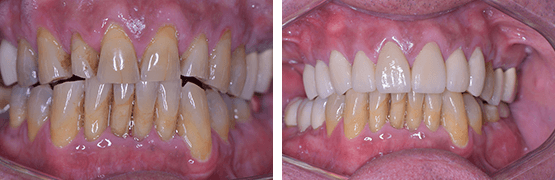 desgaste-dental-coronas-dentales-en-tijuana-libres-de-metal