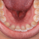 torus-mandibular-como-tratar-dentalalvarez