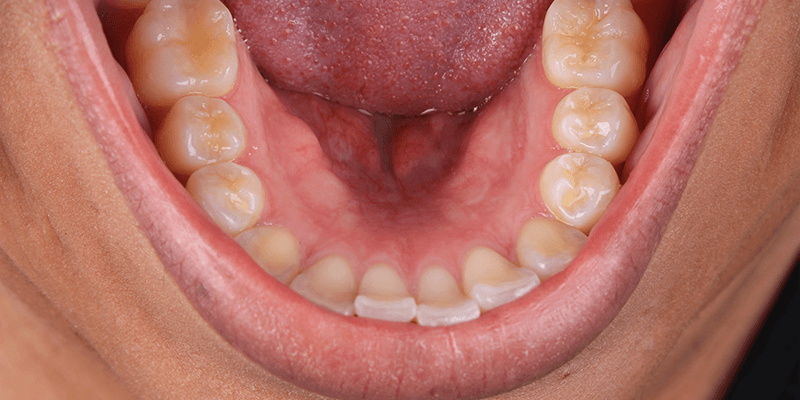 torus-mandibular-como-tratar-dentalalvarez