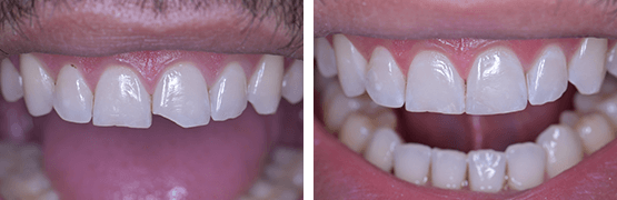 antes-y-despues-de-restauracion-dental-por-fractura-con-apariencia-natural