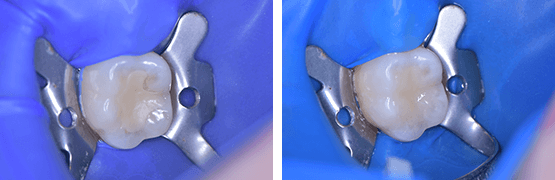 dental-composite-procedure-before-and-after-tijuana