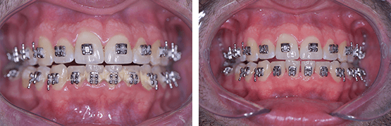 limpieza-dental-en-brackets-ortodoncia-antes-y-despues