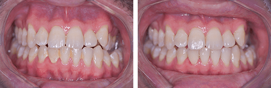 limpieza-dental-en-tijuana-antes-y-despues-dental-alvarez
