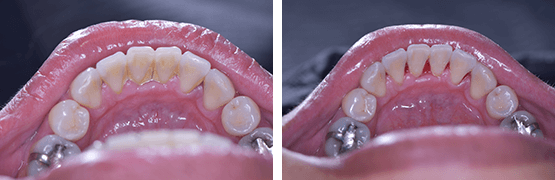limpieza-dental-en-tijuana-antes-y-despues