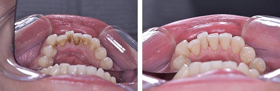 limpieza-dental-y-remocion-de-calculo-y-manchas-en-dientes