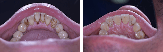 remocion-de-calculo-dental-antes-y-despues-dental-alvarez