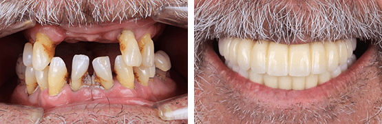 dentalalvarez-antes-y-despues-all-on-4-protesis-implantosoportada
