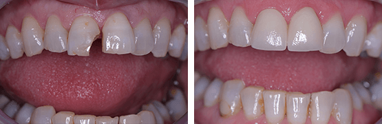 dentalalvarez-antes-y-despues-coronas-libres-de-metal-paciente-con-fracturas-y-pigmentacion