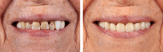dentalalvarez-antes-y-despues-coronas-para-desgaste-severo-y-pigmentacion