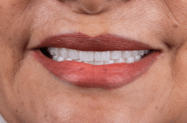 dentalalvarez-antes-y-despues-protesis-implantosoportada-inferior-y-superior-all-on-4