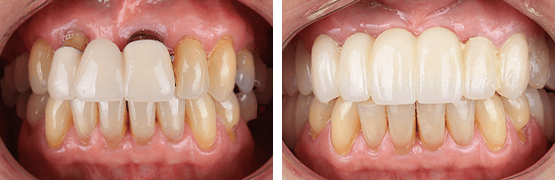 dentalalvarez-antes-y-despues-reemplazo-coronas-a-puente-libre-de-metal-zirconia