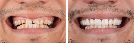 dentalalvarez-antes-y-despues-rehabilitacion-arcada-superior-coronas-libres-de-metal