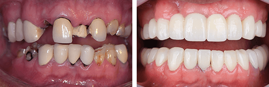 dentalalvarez-antes-y-despues-rehabilitacion-completa-paciente-con-perdida-de-piezas-dentales