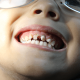 dentalalvarez-prevencion-de-caries-en-dientes-de-leche-en-tijuana