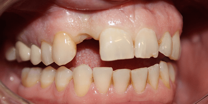 dentalalvarez-consejos-bucales-como-sustituir-un-diente-perdido