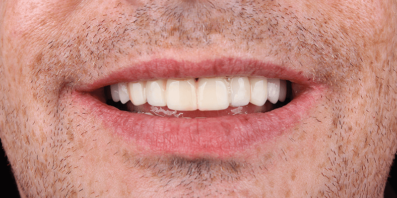 dentalalvarez-cuidados-de-la-protesis-dental-fija-para-su-salud-bucal