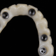 dentalalvarez-recomendaciones-sobre-uso-de-la-protesis-dental-fija