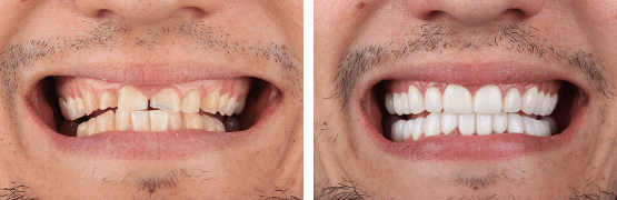 dentalalvarez-antes-y-despues-rehabilitacion-completa-coronas-libres-de-metal