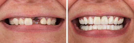 antes-y-despues-smile-makeover-y-corona-sobre-implante-dentalalvarez
