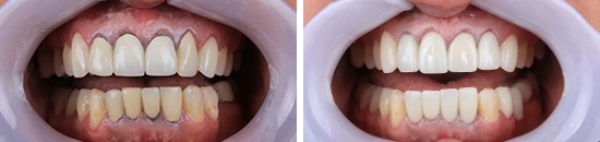 ayd-cambio-de-coronas-anteriores-superiores-dentalalvarez