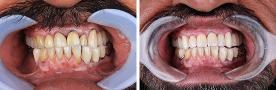 ayd-coronasdentales-dentalalvraez