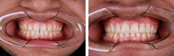 AG-dental-resin