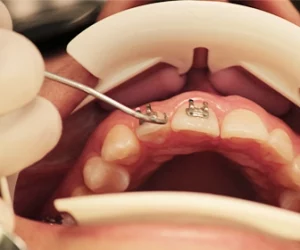 etapas-de-la-ortodoncia