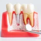 que-tipo-de-implantes-dentales-hay-y-cual-es-mejor-opcion